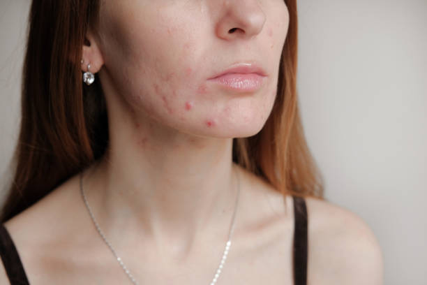 Adult Acne: Why You’re Still Breaking Out (And What You Can Do About It)